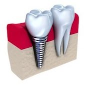 dental implants lititz pa
