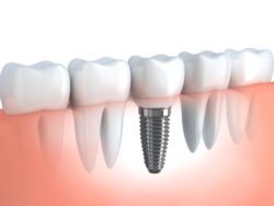 4 Essential Facts About Dental Implants