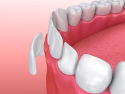Transform Your Smile With Porcelain Veneers in Lititz, PA