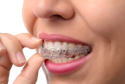 Invisalign: An Alternative to braces