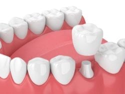 Dental Crowns Help Restore Your Smile in lititz pa
