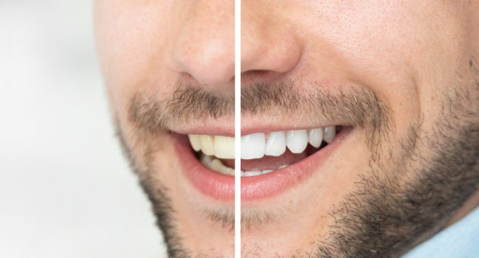 Treat Discolored Teeth in Lititz, PA