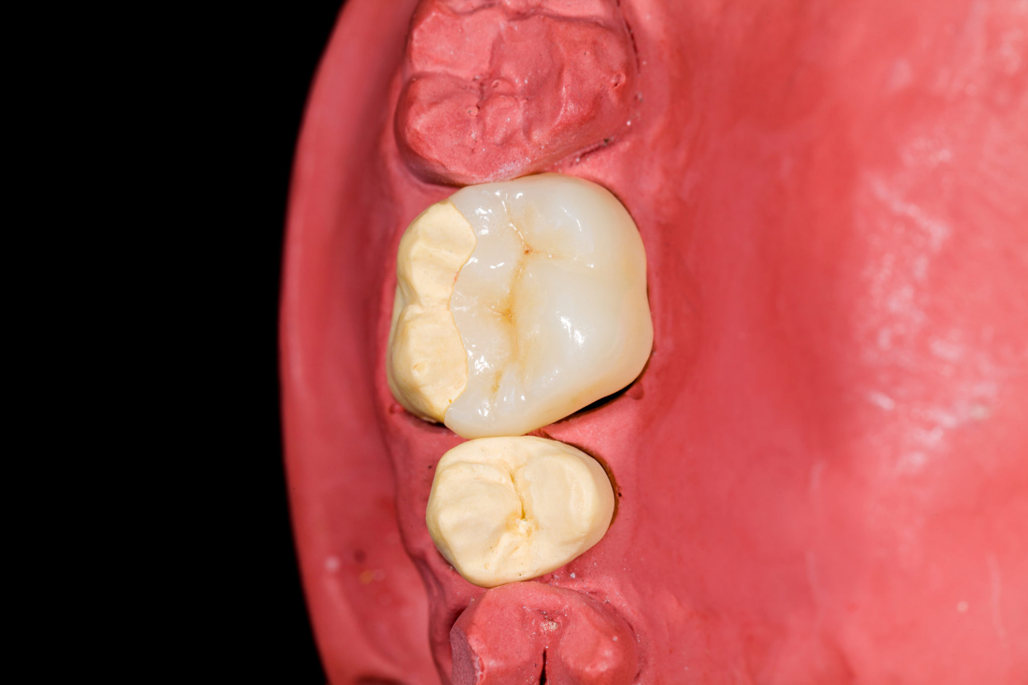 Dental Bonding and Porcelain Veneers in Lititz, Pennsylvania