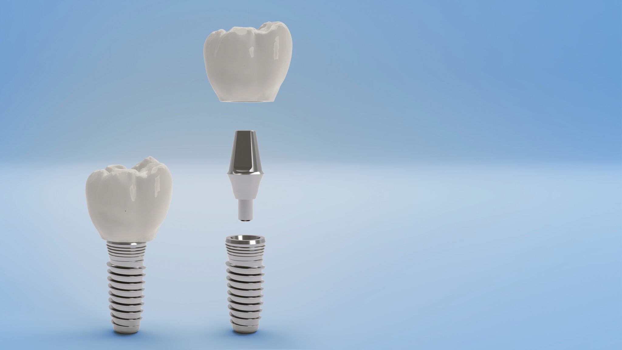 Answering Dental Implant FAQs Dentist in Lititz, PA