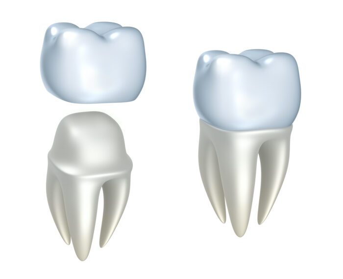 A DENTAL CROWN in LITITZ PA needs extra care and attention to last you a long time