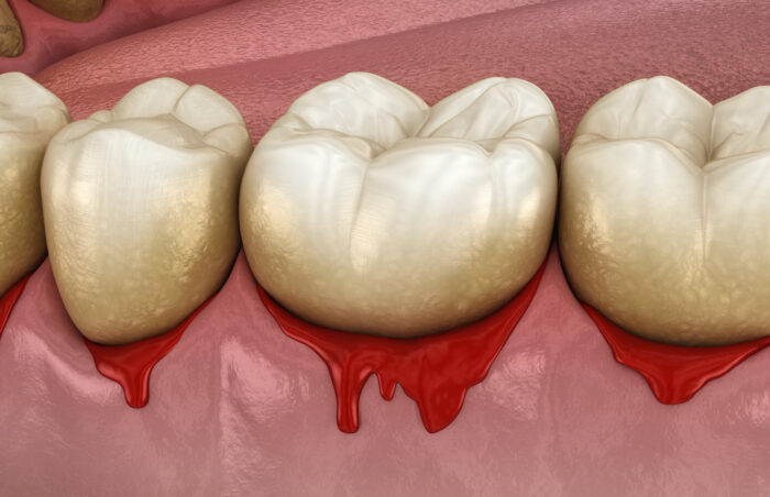 Gum disease, also known as periodontal disease, poses a significant risk to oral health, often leading to tooth loss.