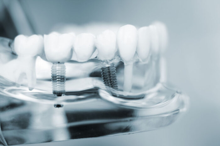 Dental bridges are common restoration options that could help improve your smile and bite after tooth loss.