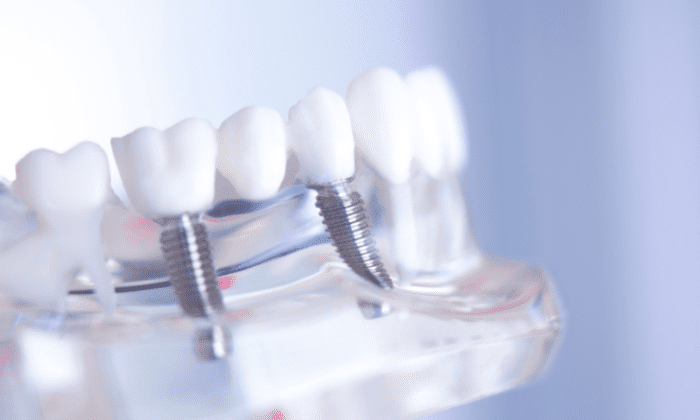 Understanding the various types of dental bridges can aid in making informed decisions about your oral health.